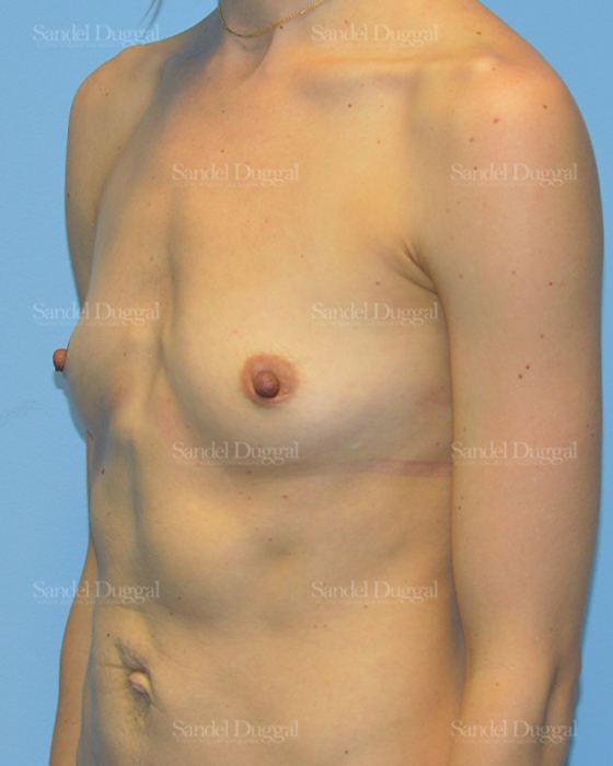 Breast Augmentation before, case 3087