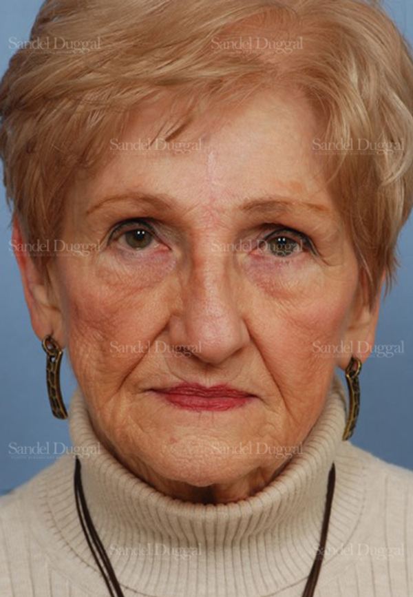 Reconstruction after Mohs after, case 2757