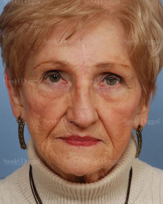 Reconstruction after Mohs after, case 2757