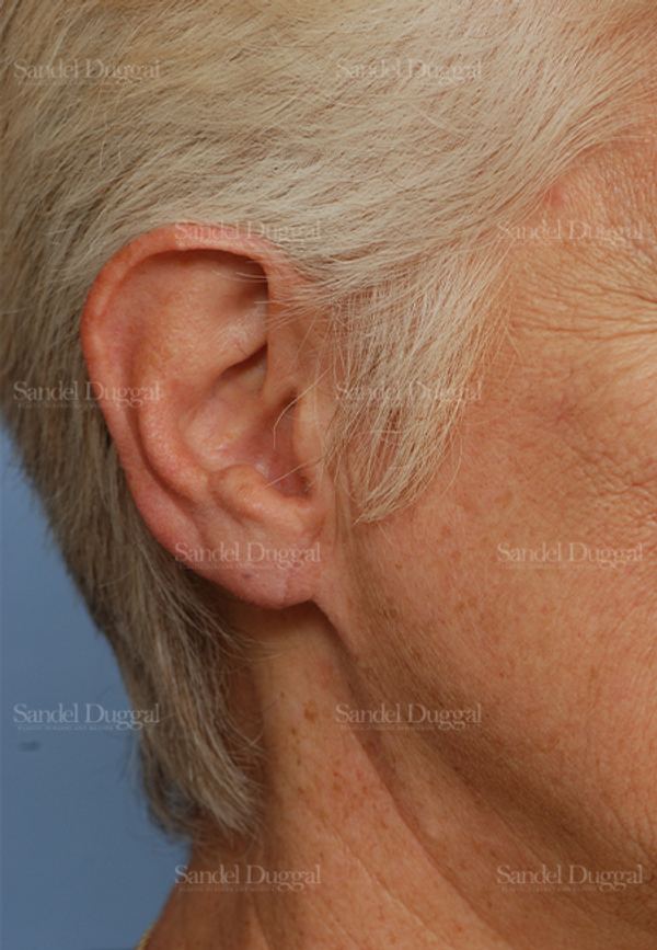 Earlobe Repair after, case 2573