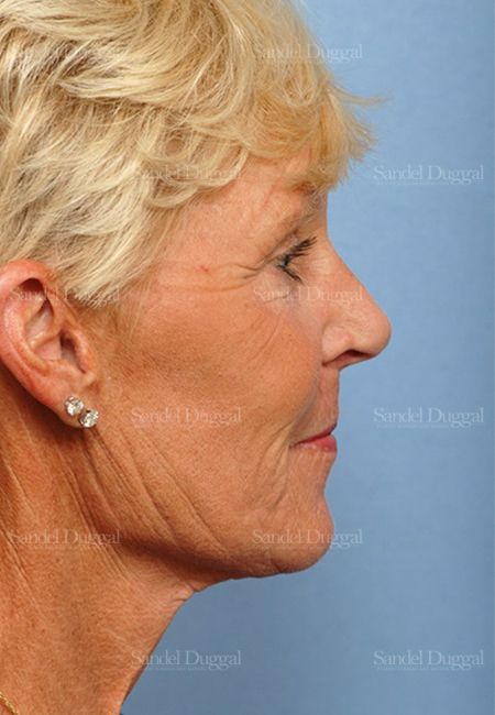 Facelift after, case 2707