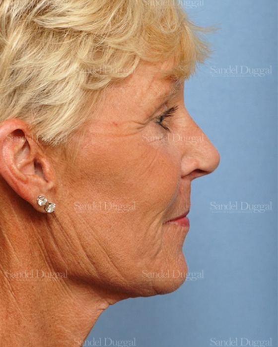 Facelift after, case 2707