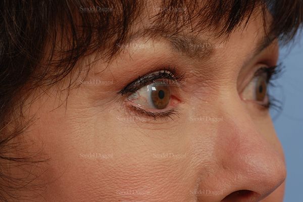 Eyelid Rejuvenation after, case 1971