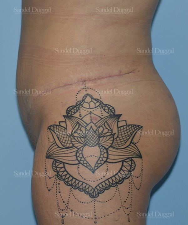 Liposuction — Legs & Flanks after, case 2515