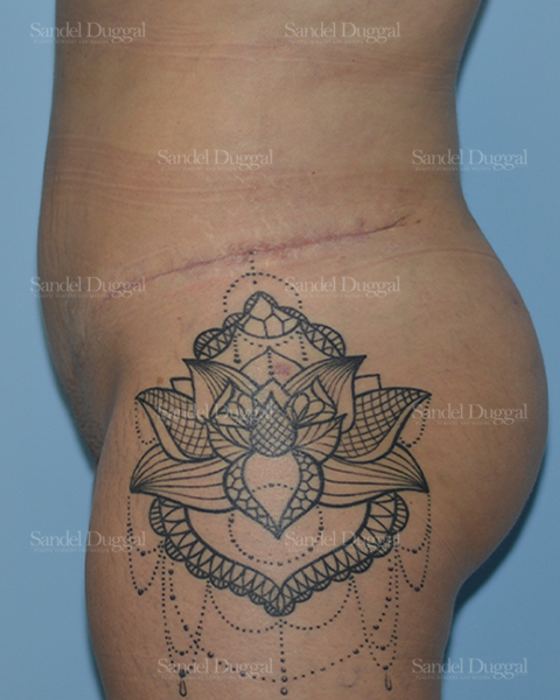 Liposuction — Legs & Flanks after, case 2515