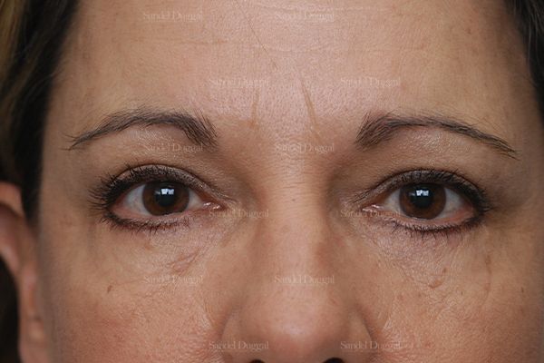 Eyelid Rejuvenation after, case 1900