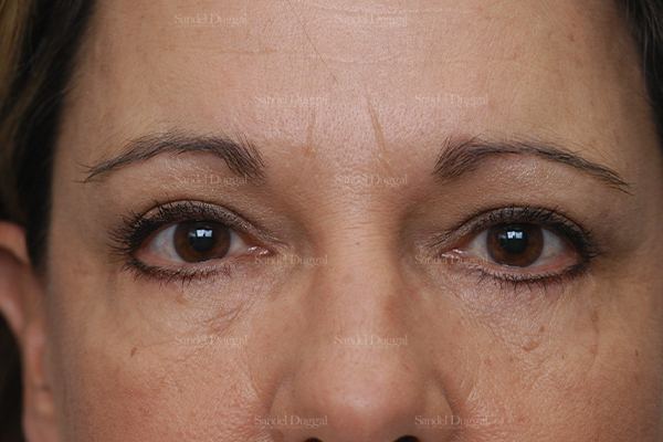 Eyelid Rejuvenation after, case 1900