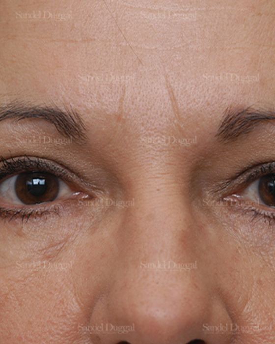 Eyelid Rejuvenation after, case 1900