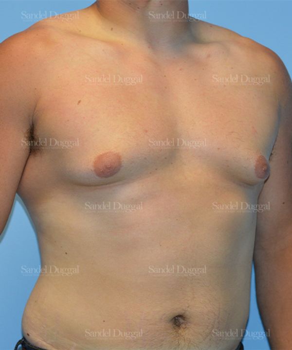 Gynecomastia before, case 1454