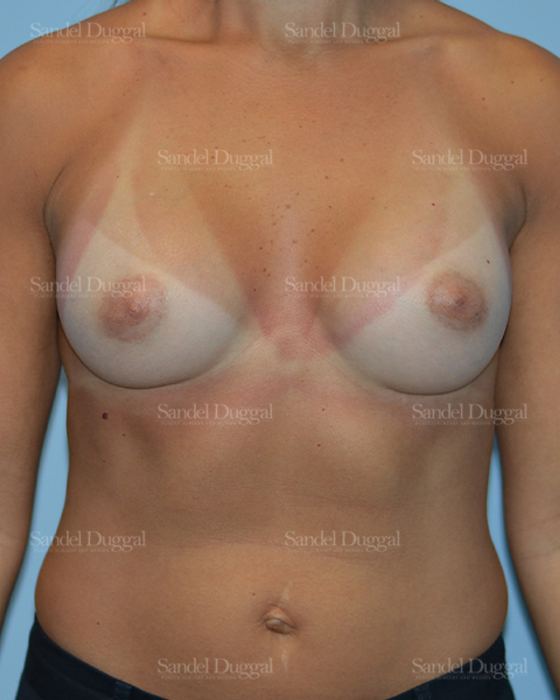 Breast Augmentation after, case 3143