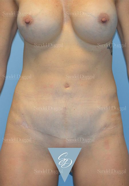 Mommy Makeover after, case 2176