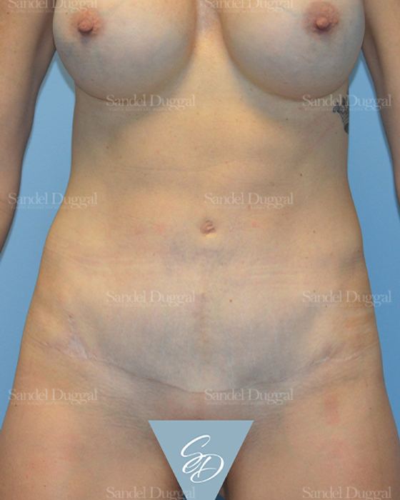 Mommy Makeover after, case 2176