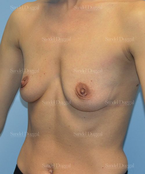 Breast Augmentation before, case 3227