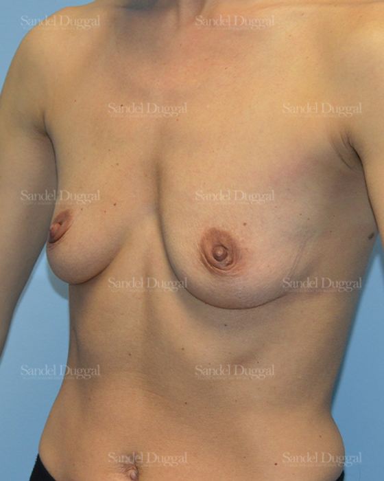 Breast Augmentation before, case 3227