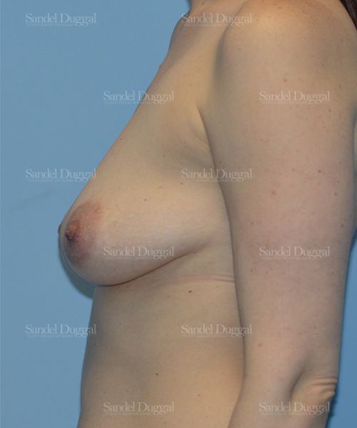 Breast Augmentation with Lift before, case 3379