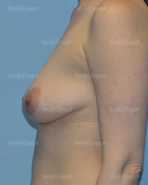 Breast Augmentation with Lift before, case 3379