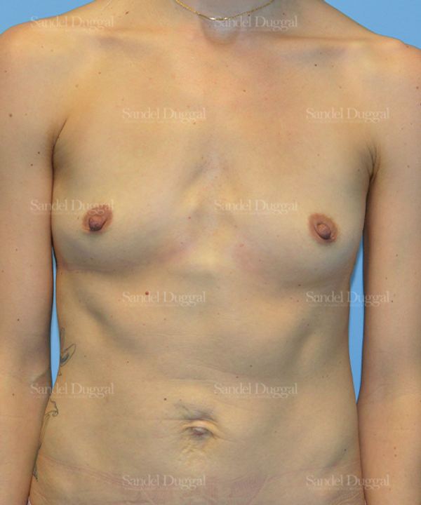 Breast Augmentation before, case 3087