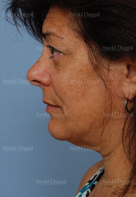 Facelift before, case 2671
