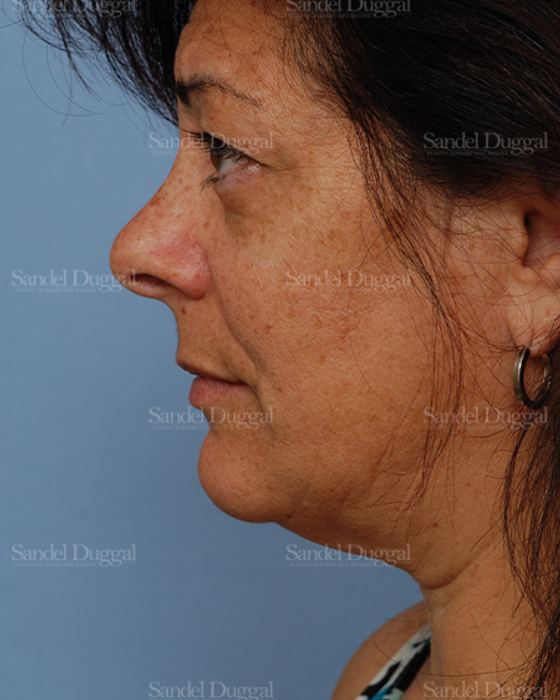 Facelift before, case 2671