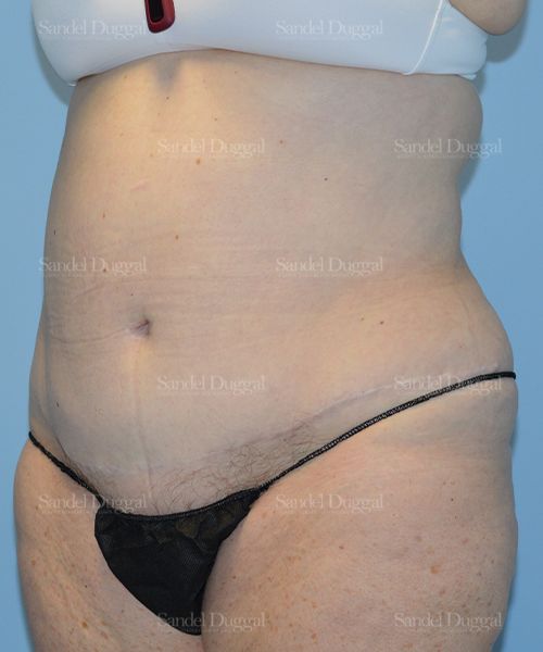 Liposuction — Abdomen before, case 2464