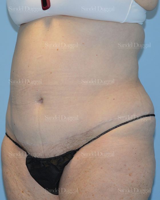 Liposuction — Abdomen before, case 2464