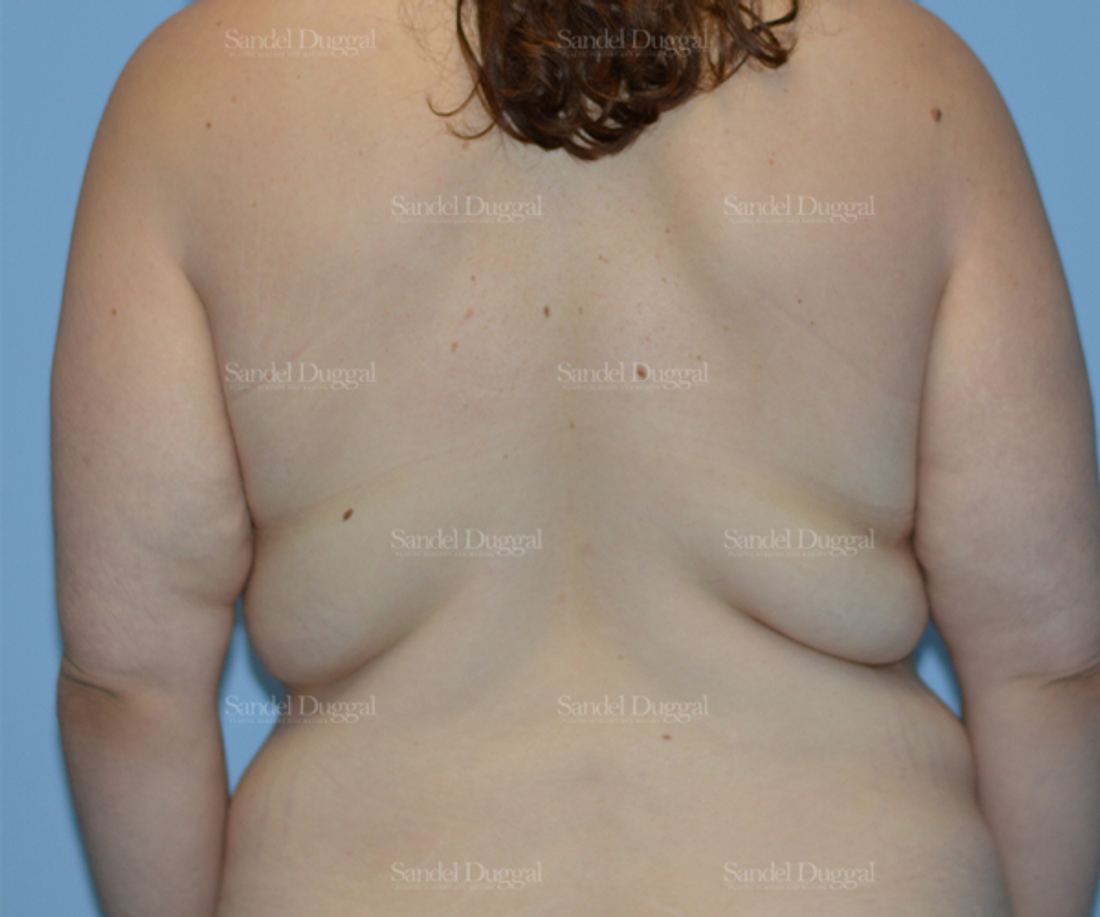 Brachioplasty before and after, case 2156