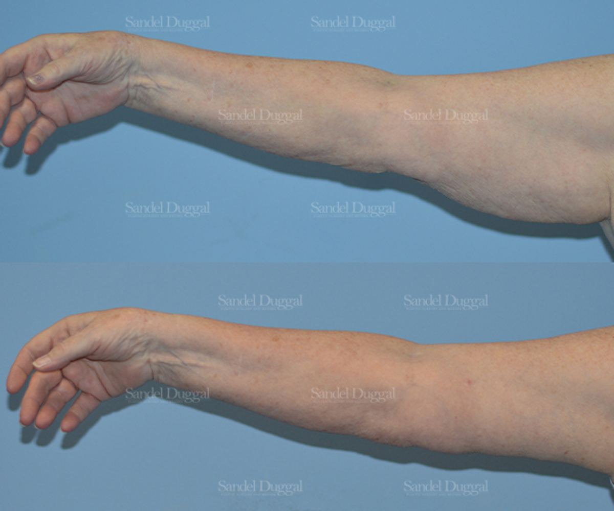 Brachioplasty before and after, case 2113