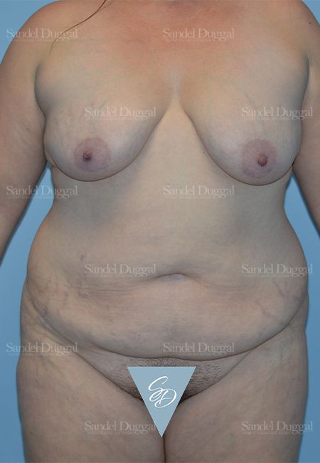 Mommy Makeover before, case 2190
