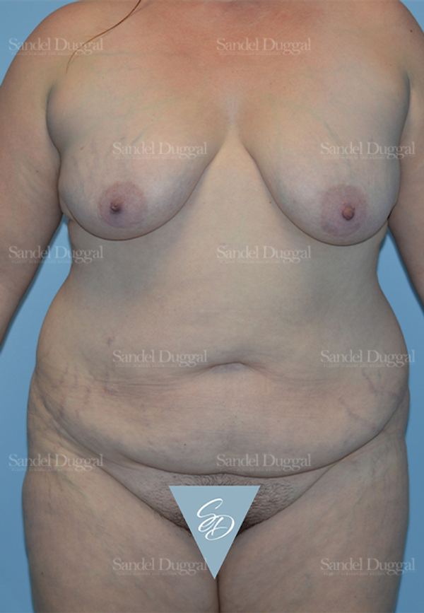 Mommy Makeover before, case 2190