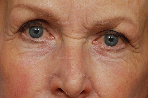 Eyelid Rejuvenation after, case 1951