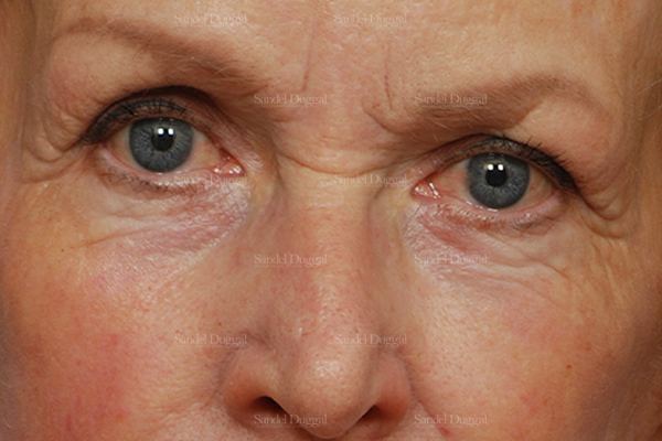 Eyelid Rejuvenation after, case 1951