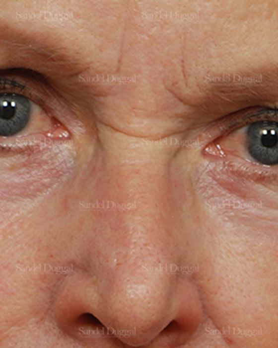 Eyelid Rejuvenation after, case 1951