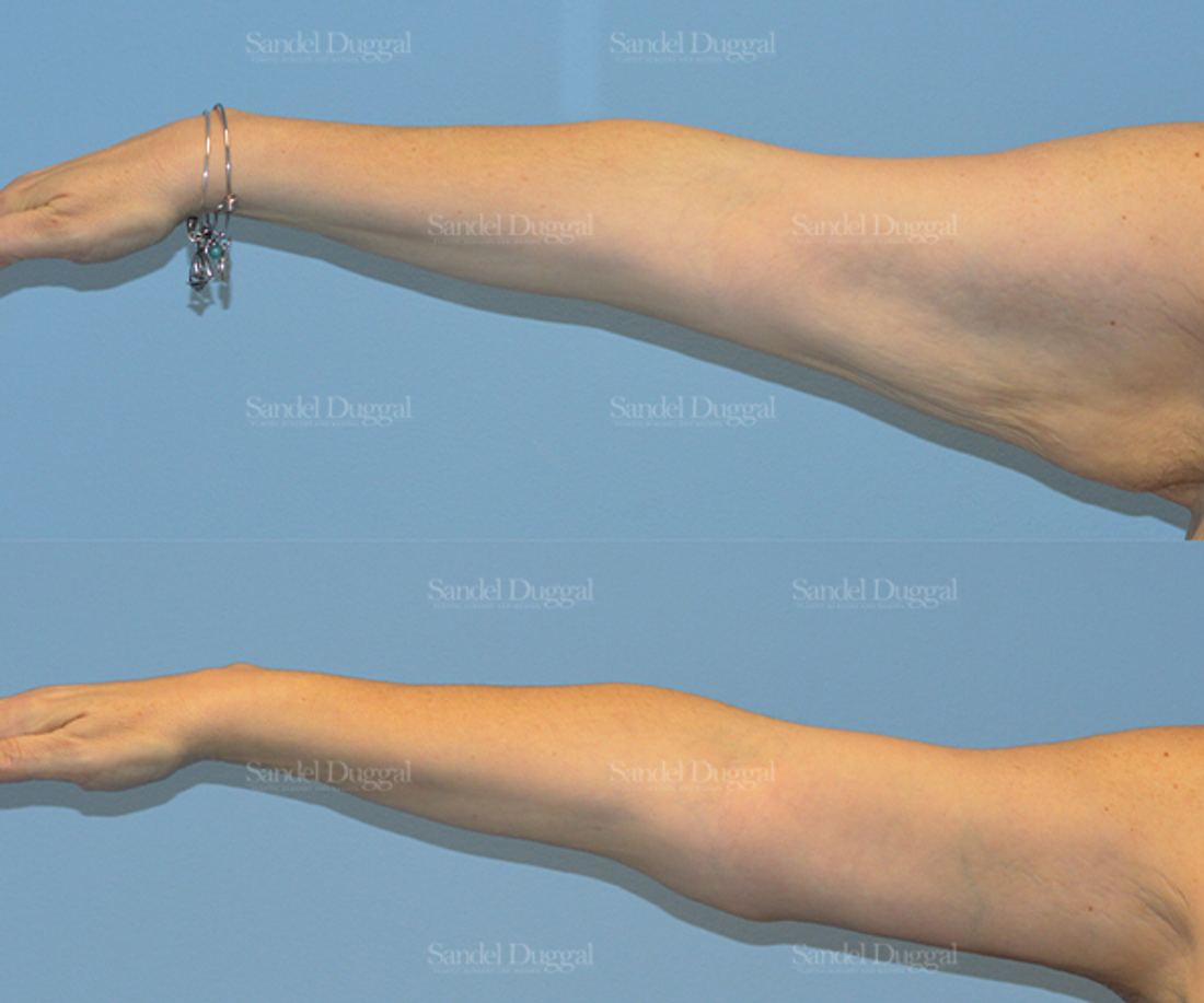 Brachioplasty before and after, case 2123