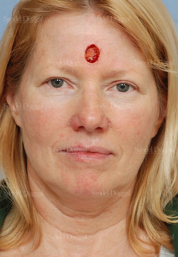 Reconstruction after Mohs before, case 2766