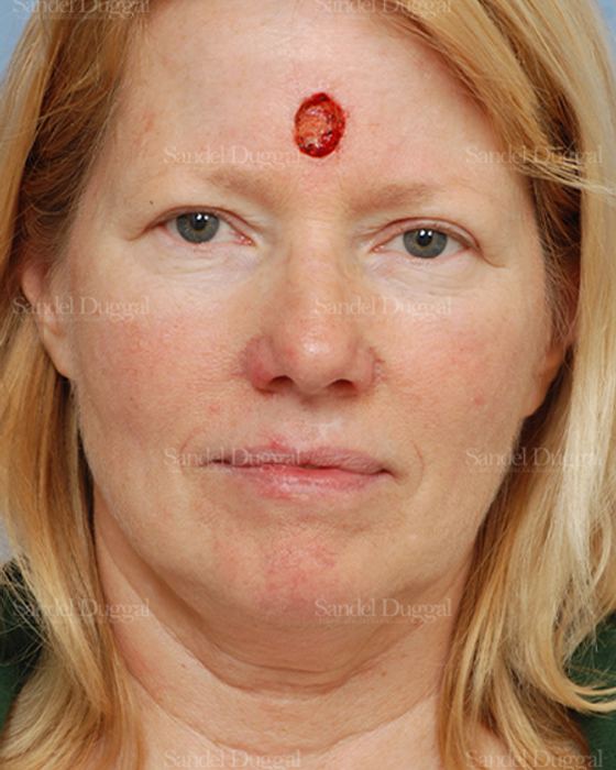 Reconstruction after Mohs before, case 2766