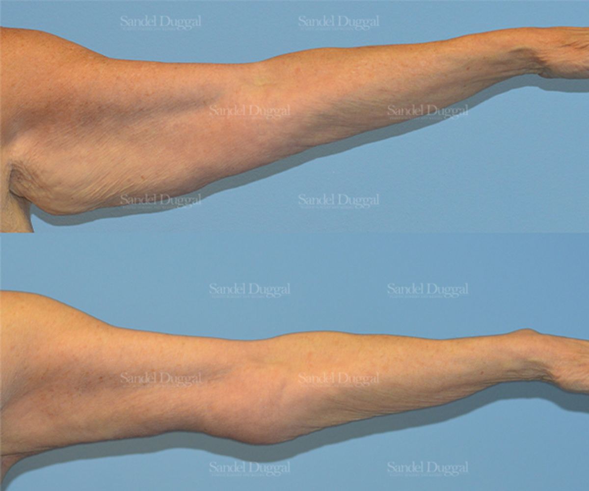 Brachioplasty before and after, case 2144