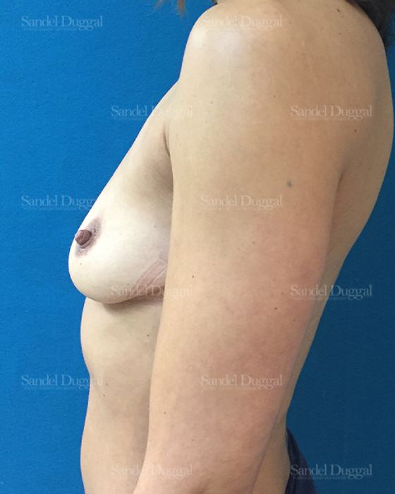 Breast Augmentation before, case 3150