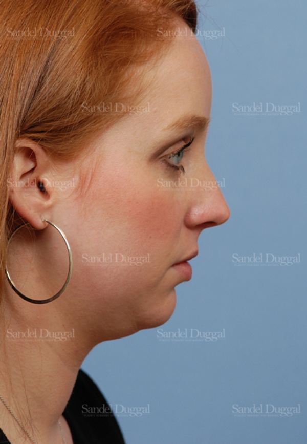 Neck & Chin Liposuction before, case 2027