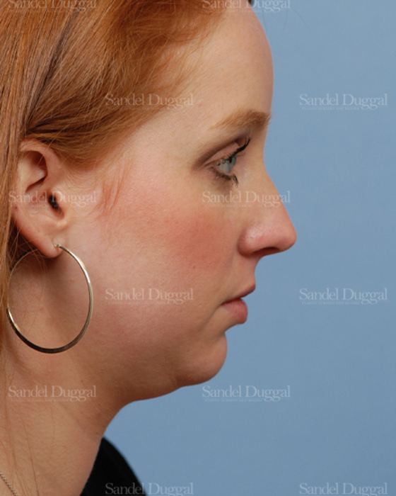 Neck & Chin Liposuction before, case 2027