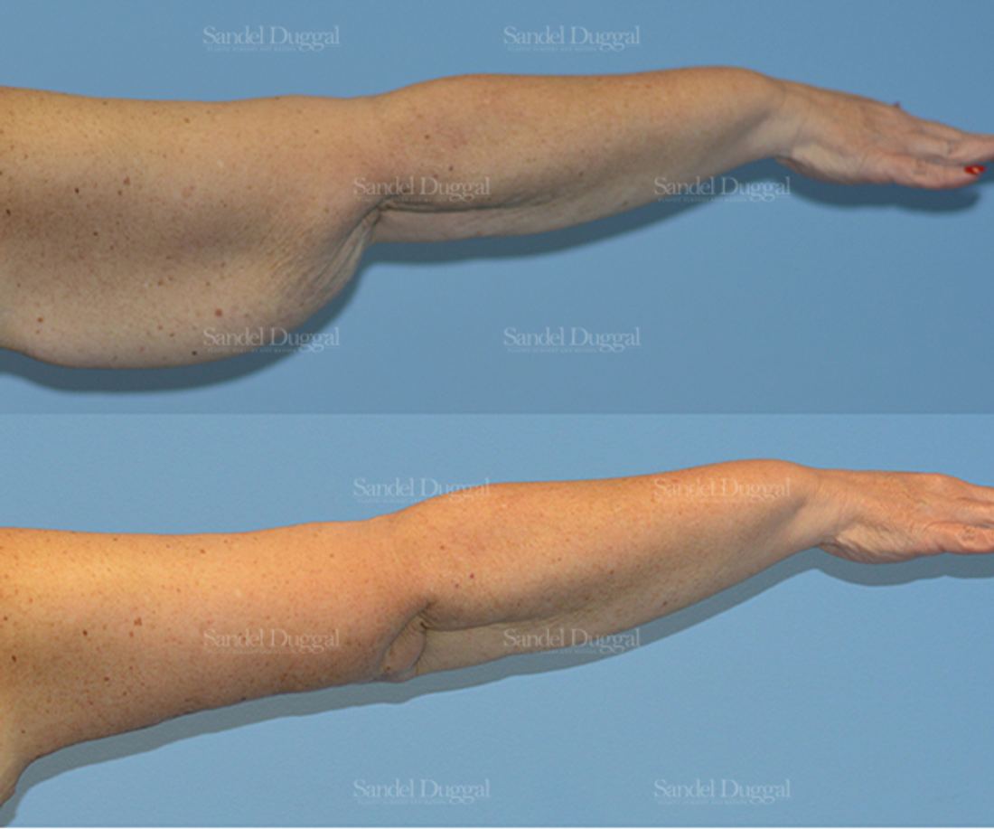 Brachioplasty before and after, case 2139
