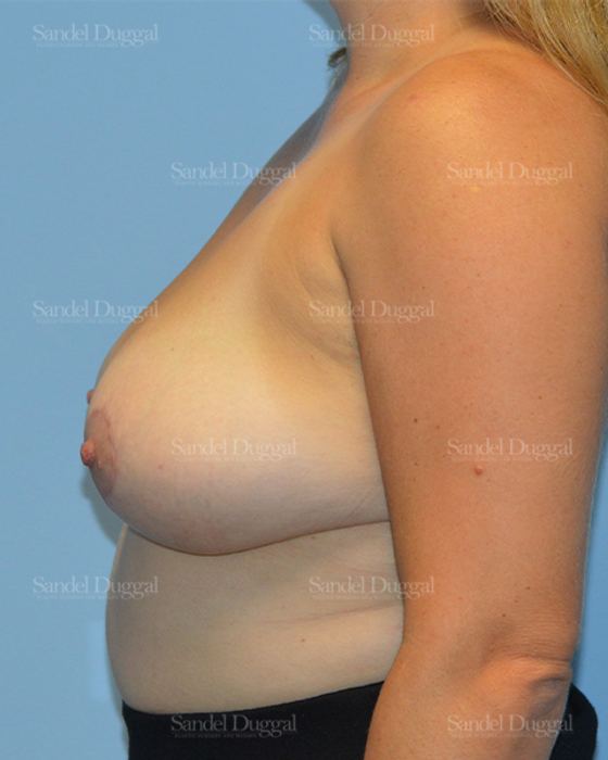 Breast Lift after, case 3308