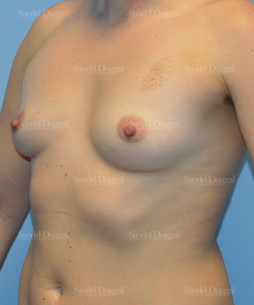 Breast Augmentation before, case 3122
