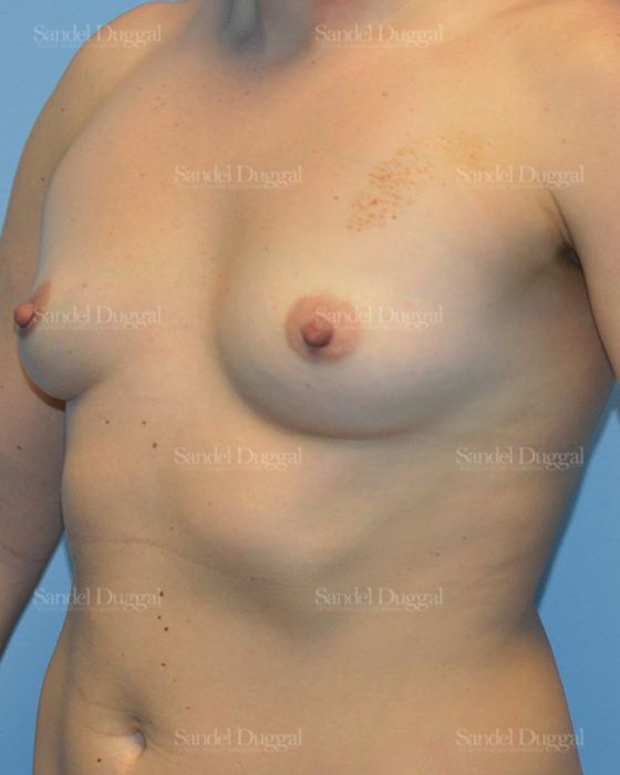 Breast Augmentation before, case 3122