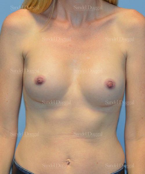Breast Augmentation after, case 3241