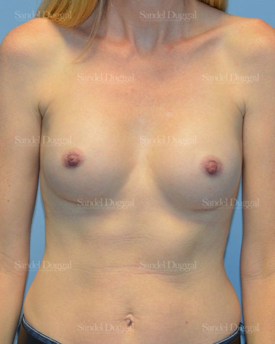 Breast Augmentation after, case 3241