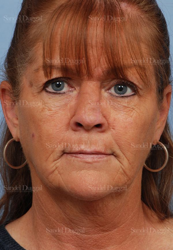 Reconstruction after Mohs after, case 2799