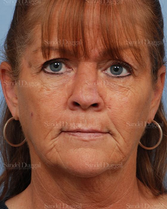 Reconstruction after Mohs after, case 2799