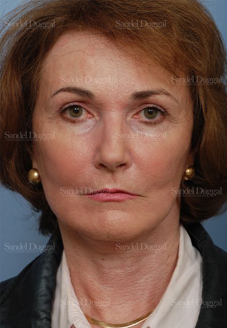 Cheek Augmentation after, case 1427