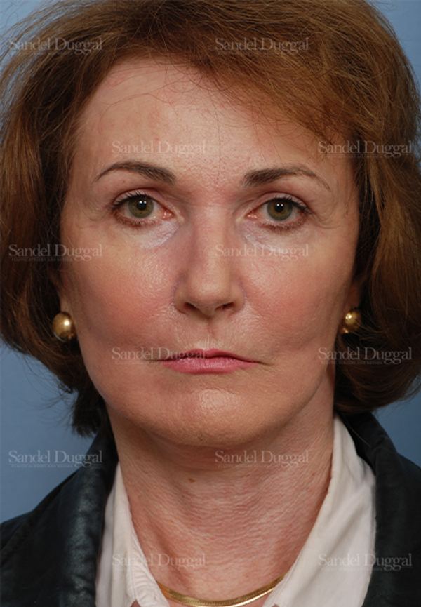 Cheek Augmentation after, case 1427