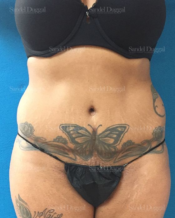 Liposuction — Legs & Flanks before, case 2504